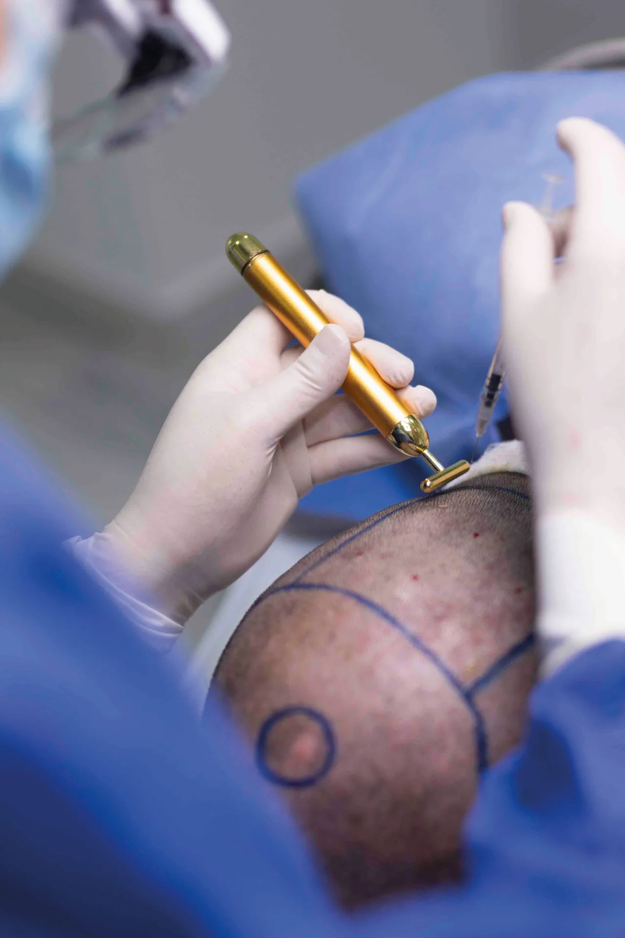 Mesoterapia Capilar 1 meso2